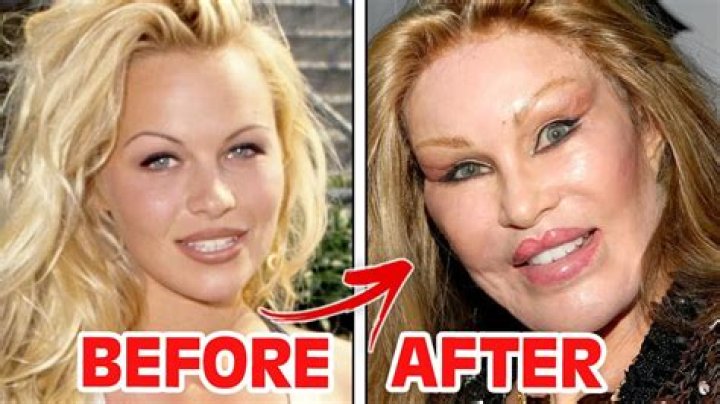 10 Celebrities Who Spent the Most on Plastic Surgery