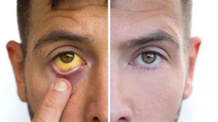 Young MA Health Condition – Does She Have Hepatitis? Yellow Eyes Condition And Family